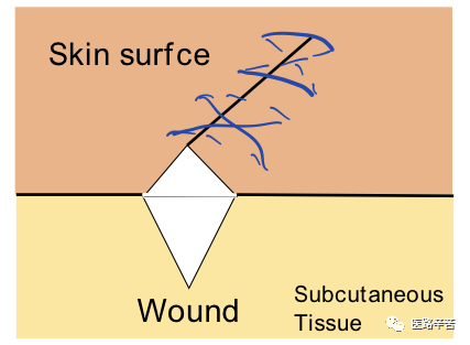 缝合线怎么消毒关于急诊清创缝合术必须掌握的知识_https://www.jmylbn.com_新闻资讯_第16张