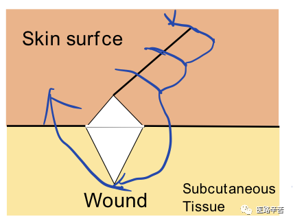 缝合线怎么消毒关于急诊清创缝合术必须掌握的知识_https://www.jmylbn.com_新闻资讯_第18张