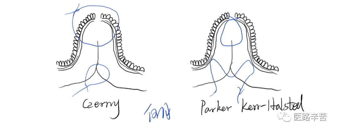 缝合线怎么消毒关于急诊清创缝合术必须掌握的知识_https://www.jmylbn.com_新闻资讯_第21张