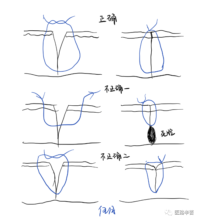 缝合线怎么消毒关于急诊清创缝合术必须掌握的知识_https://www.jmylbn.com_新闻资讯_第15张