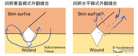 缝合线怎么消毒关于急诊清创缝合术必须掌握的知识_https://www.jmylbn.com_新闻资讯_第23张
