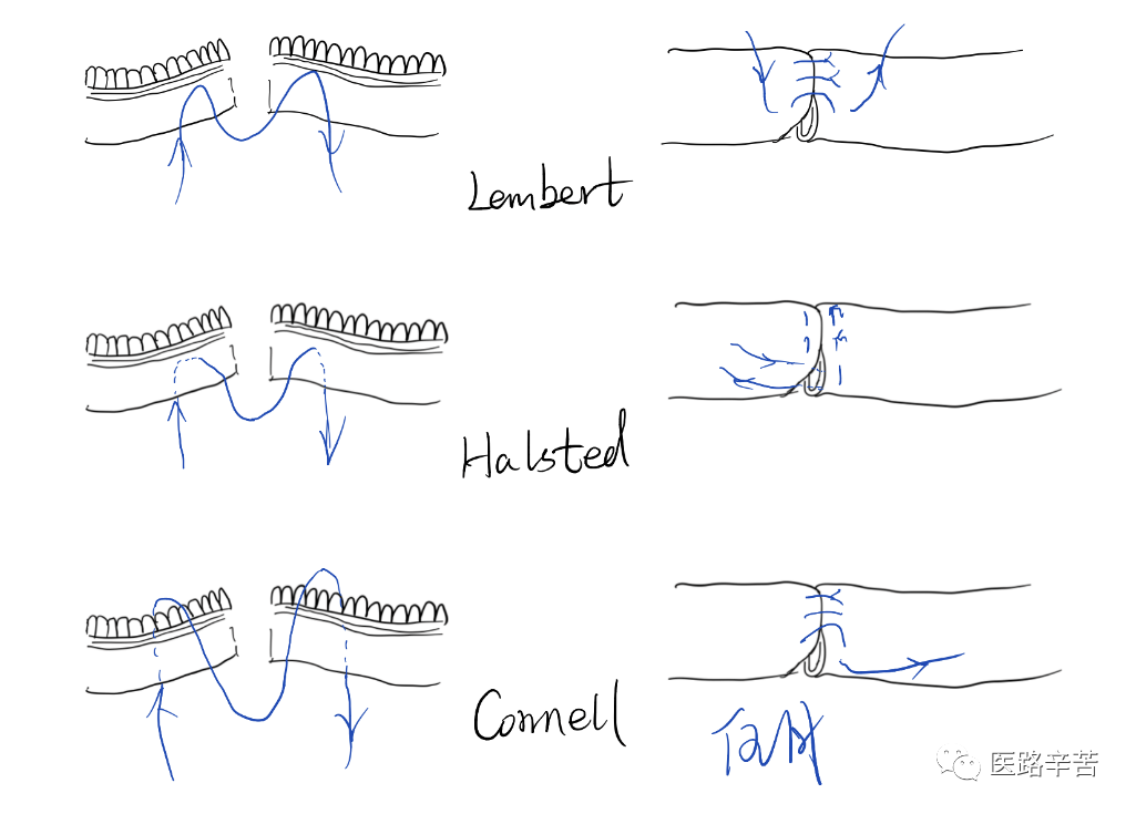 缝合线怎么消毒关于急诊清创缝合术必须掌握的知识_https://www.jmylbn.com_新闻资讯_第20张