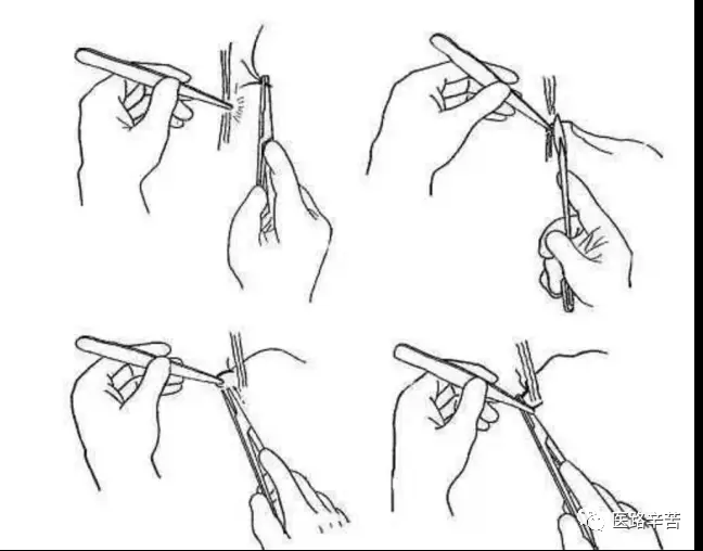 缝合线怎么消毒关于急诊清创缝合术必须掌握的知识_https://www.jmylbn.com_新闻资讯_第14张