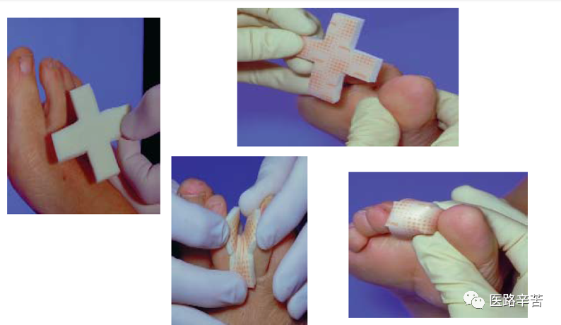 伤口贴敷料为什么伤口敷料的分类与选择技巧_https://www.jmylbn.com_新闻资讯_第14张