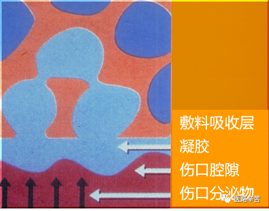 伤口贴敷料为什么伤口敷料的分类与选择技巧_https://www.jmylbn.com_新闻资讯_第8张