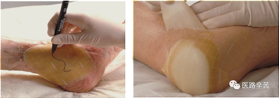 伤口贴敷料为什么伤口敷料的分类与选择技巧_https://www.jmylbn.com_新闻资讯_第11张