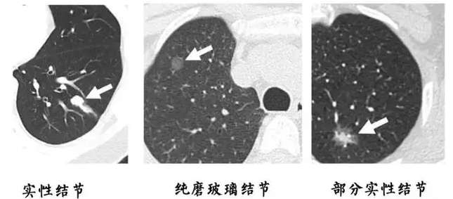 肺部结节 肺部结节