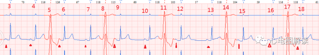 p心电图功能怎么开通【心电图解读】如何寻找插入性室性早搏后的窦P_https://www.jmylbn.com_新闻资讯_第3张