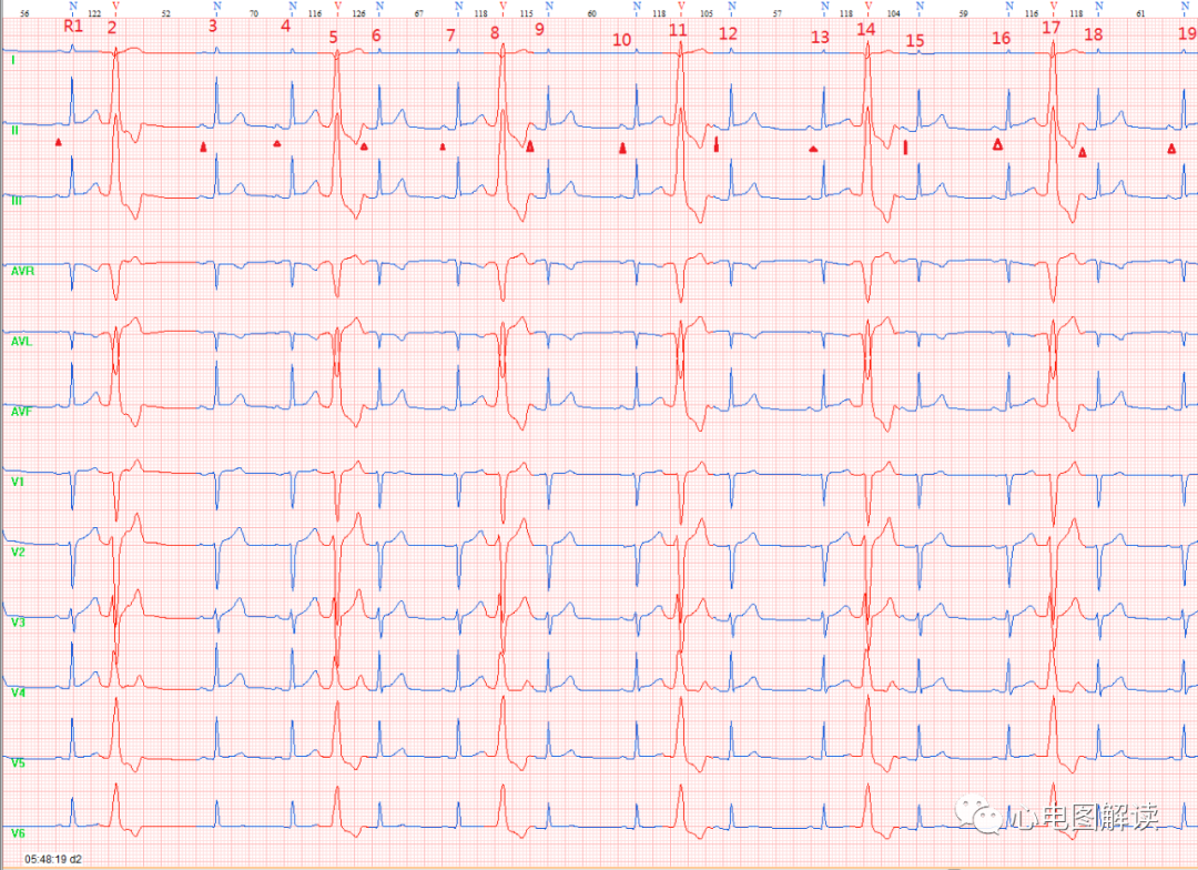 p心电图功能怎么开通【心电图解读】如何寻找插入性室性早搏后的窦P_https://www.jmylbn.com_新闻资讯_第2张