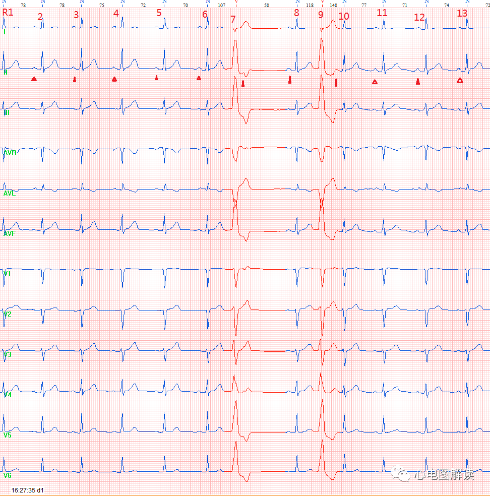 p心电图功能怎么开通【心电图解读】如何寻找插入性室性早搏后的窦P_https://www.jmylbn.com_新闻资讯_第1张
