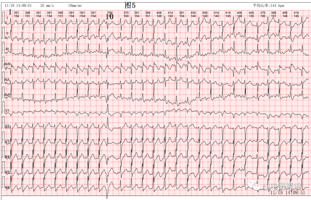 动心电图怎么弄2：1的心房扑动，室早和差传的鉴别_https://www.jmylbn.com_新闻资讯_第5张