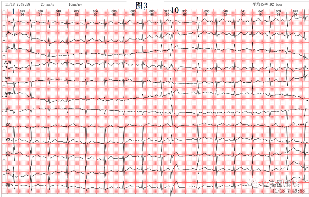 动心电图怎么弄2：1的心房扑动，室早和差传的鉴别_https://www.jmylbn.com_新闻资讯_第3张