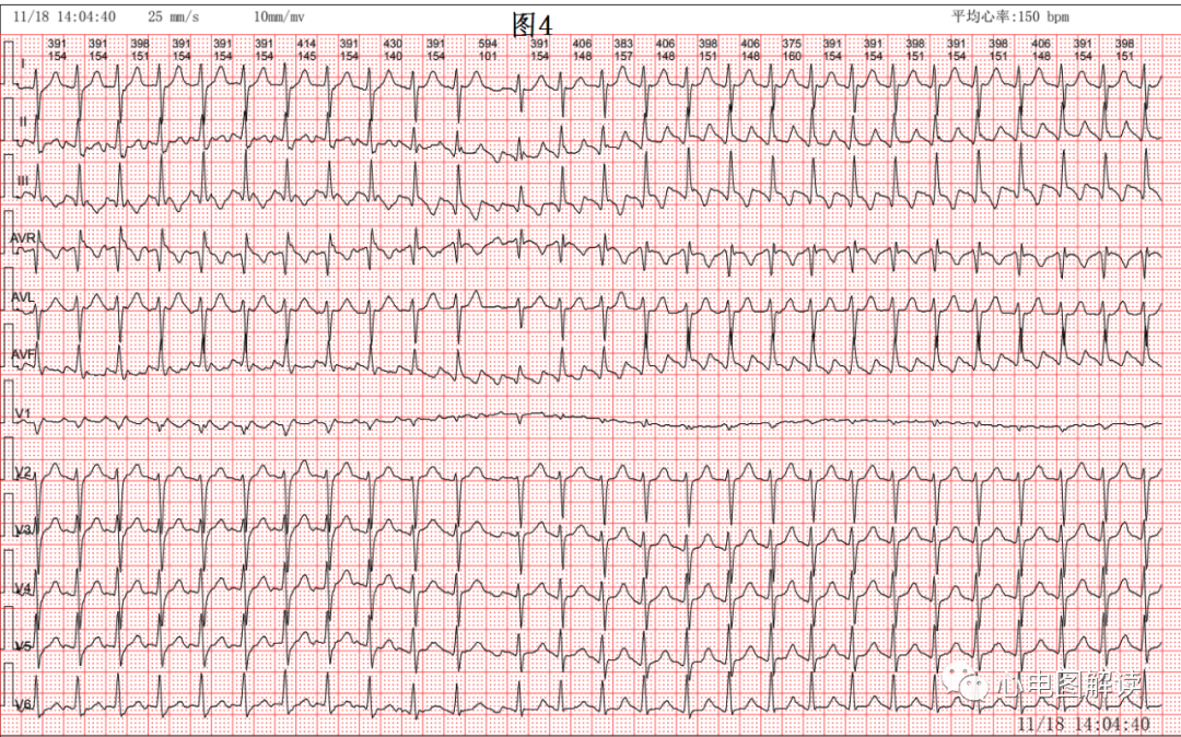 动心电图怎么弄2：1的心房扑动，室早和差传的鉴别_https://www.jmylbn.com_新闻资讯_第4张