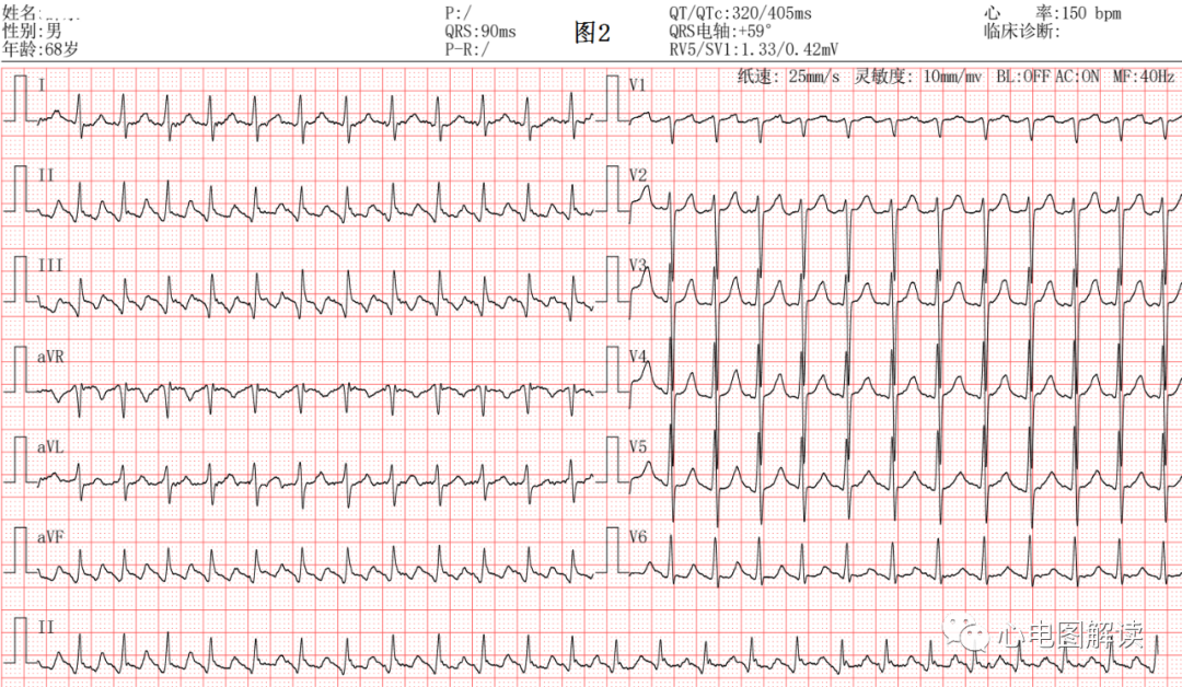 动心电图怎么弄2：1的心房扑动，室早和差传的鉴别_https://www.jmylbn.com_新闻资讯_第2张