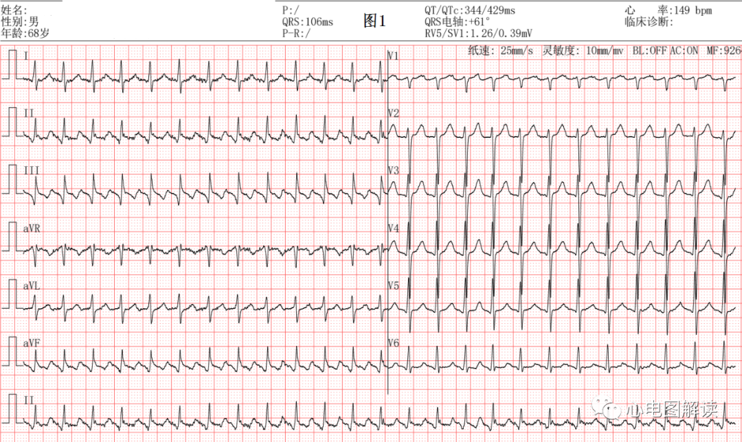 动心电图怎么弄2：1的心房扑动，室早和差传的鉴别_https://www.jmylbn.com_新闻资讯_第1张
