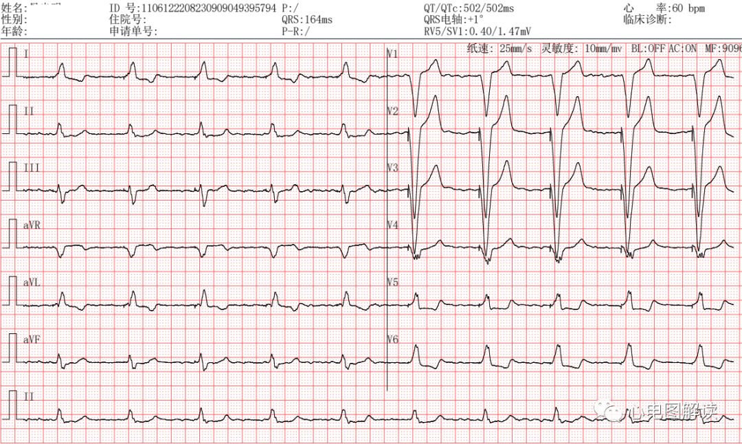 心电图滤波怎么选择滤波和心室单腔起搏器_https://www.jmylbn.com_新闻资讯_第1张