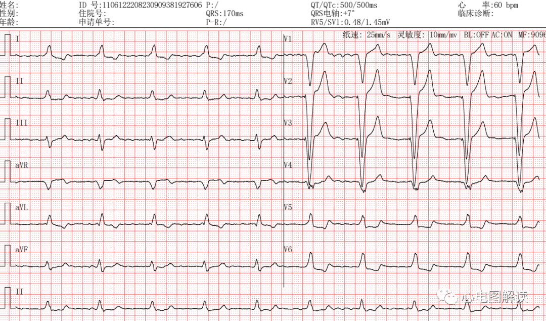 心电图滤波怎么选择滤波和心室单腔起搏器_https://www.jmylbn.com_新闻资讯_第2张
