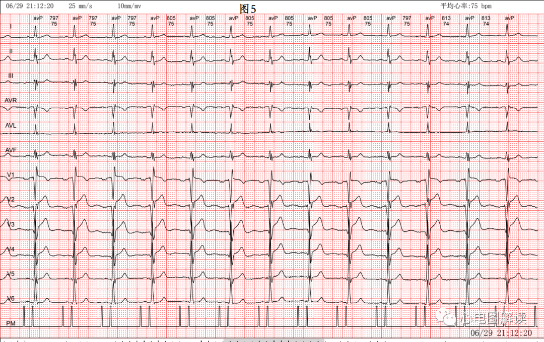 心电图器怎么用双腔起搏器最常见的2种工作方式及BFS_https://www.jmylbn.com_新闻资讯_第6张