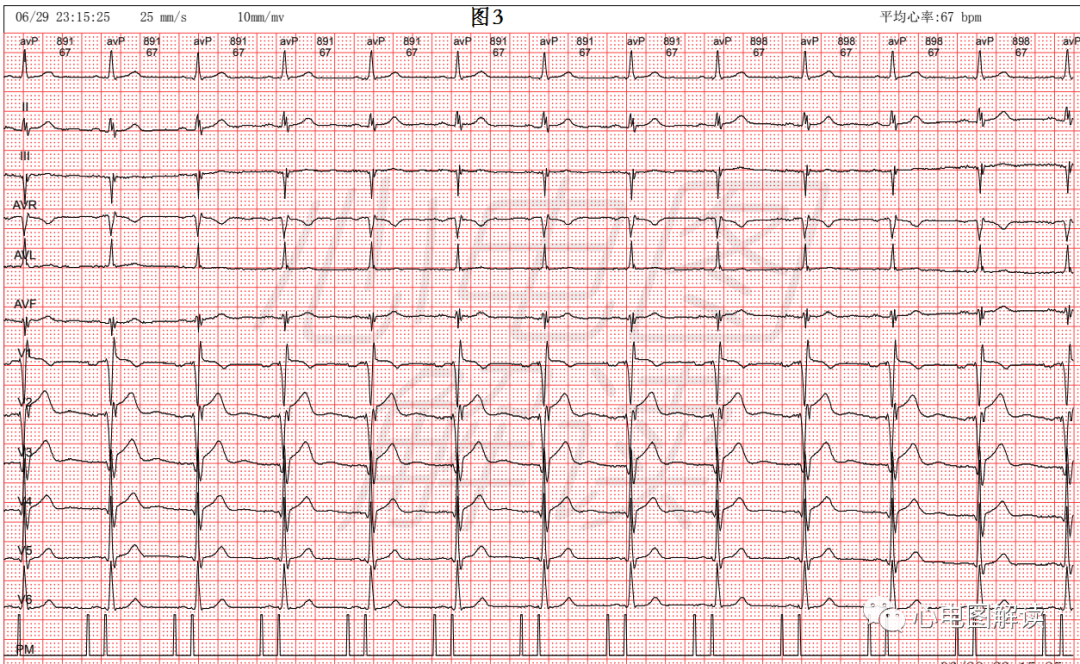 心电图器怎么用双腔起搏器最常见的2种工作方式及BFS_https://www.jmylbn.com_新闻资讯_第5张