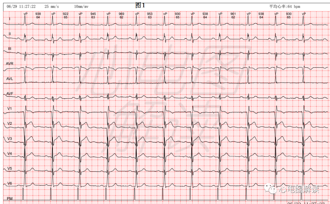 心电图器怎么用双腔起搏器最常见的2种工作方式及BFS_https://www.jmylbn.com_新闻资讯_第2张