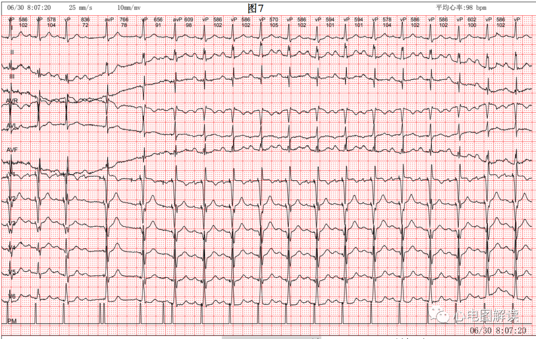 心电图器怎么用双腔起搏器最常见的2种工作方式及BFS_https://www.jmylbn.com_新闻资讯_第8张