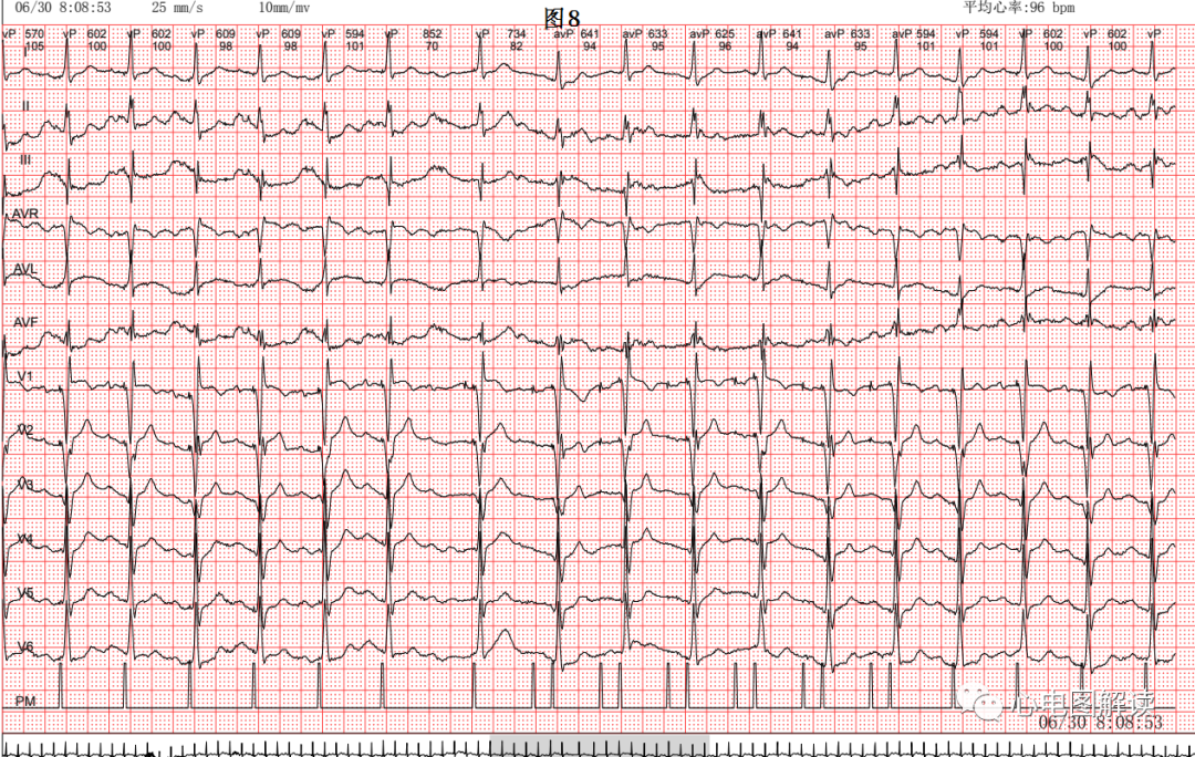 心电图器怎么用双腔起搏器最常见的2种工作方式及BFS_https://www.jmylbn.com_新闻资讯_第9张