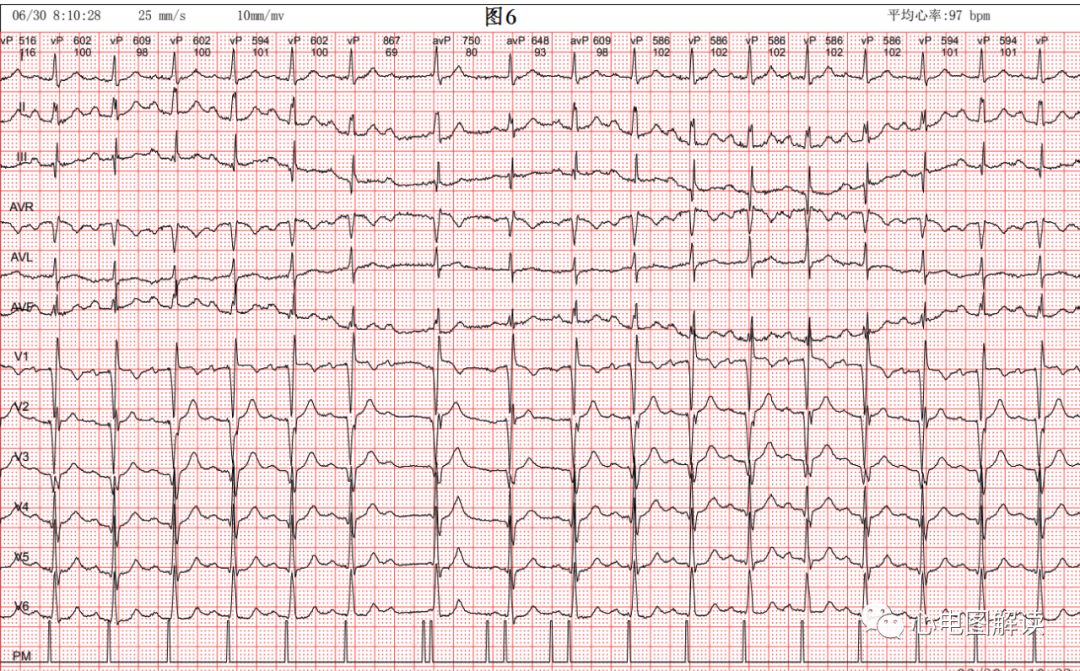 心电图器怎么用双腔起搏器最常见的2种工作方式及BFS_https://www.jmylbn.com_新闻资讯_第7张