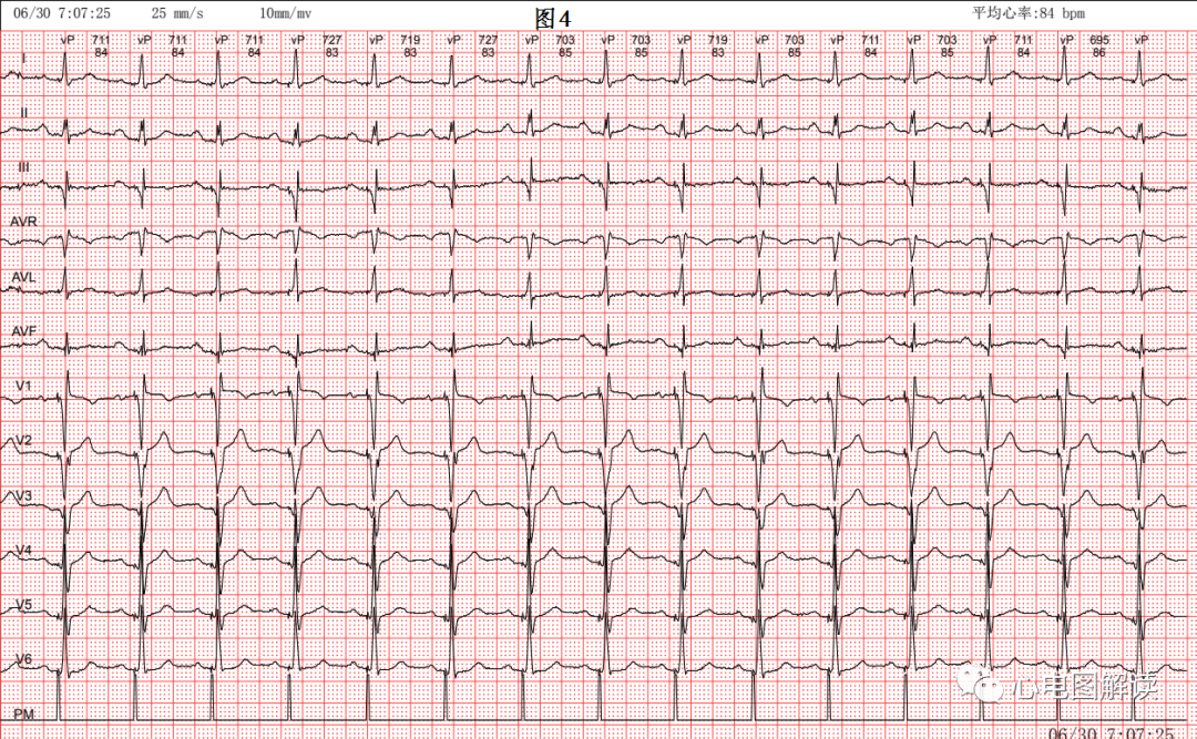 心电图器怎么用双腔起搏器最常见的2种工作方式及BFS_https://www.jmylbn.com_新闻资讯_第4张