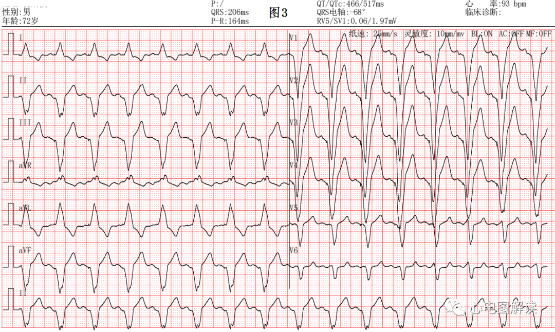 心电图器怎么用常见的起搏器心电图4例_https://www.jmylbn.com_新闻资讯_第3张