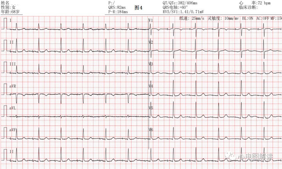 心电图器怎么用常见的起搏器心电图4例_https://www.jmylbn.com_新闻资讯_第4张