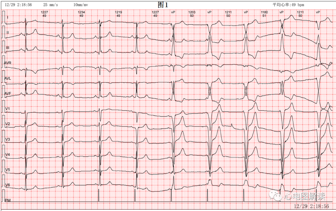 心电图器怎么用常见的起搏器心电图4例_https://www.jmylbn.com_新闻资讯_第1张