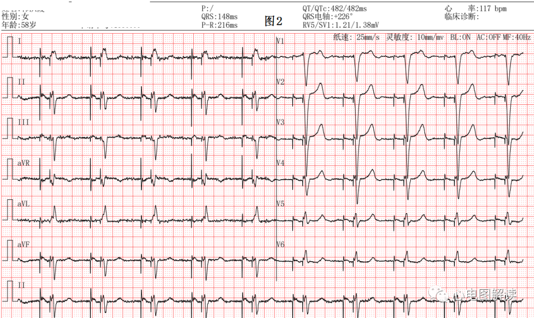 心电图器怎么用常见的起搏器心电图4例_https://www.jmylbn.com_新闻资讯_第2张