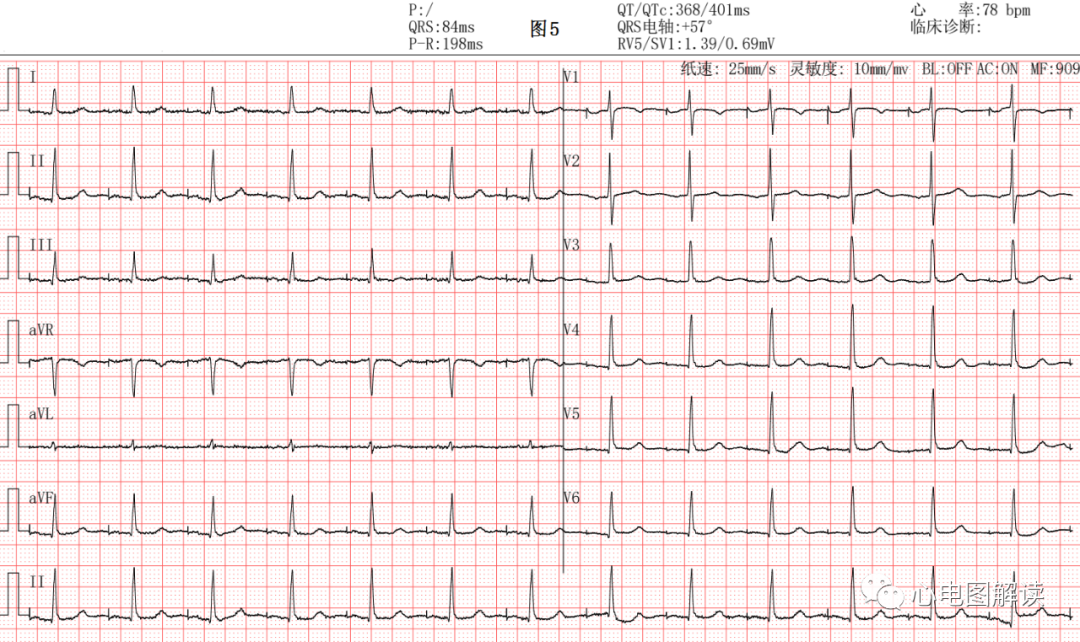 心电图器怎么用常见的起搏器心电图4例_https://www.jmylbn.com_新闻资讯_第5张