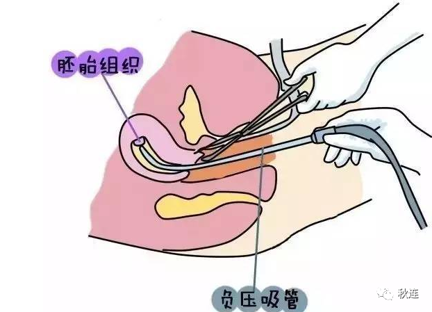 宫颈钳是什么图片带你了解：清宫术过程真实图片-上海聚慕医疗器械有限公司