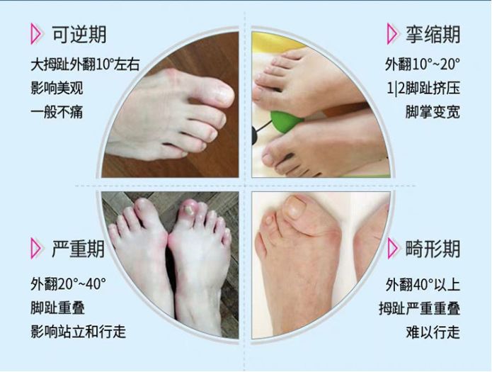 拇指外翻竟然会这么严重