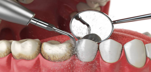 ems洁牙机怎么用EMS洁牙，一种全新的洁牙体验！_https://www.jmylbn.com_新闻资讯_第5张