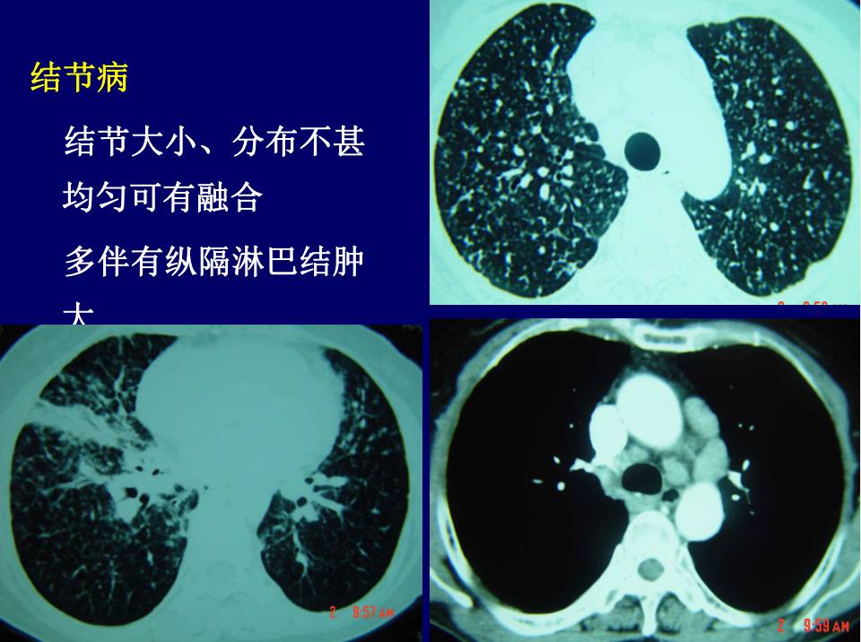 圖21:結節病