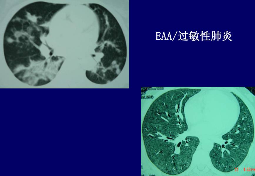 呼吸性細支氣管炎伴間質性肺病( rbild ),見圖12 3.