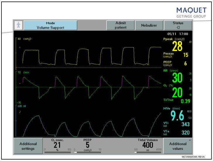 呼吸机压力怎么设置「基础篇」呼吸机模式及参数设置，快速上手！_https://www.jmylbn.com_新闻资讯_第17张