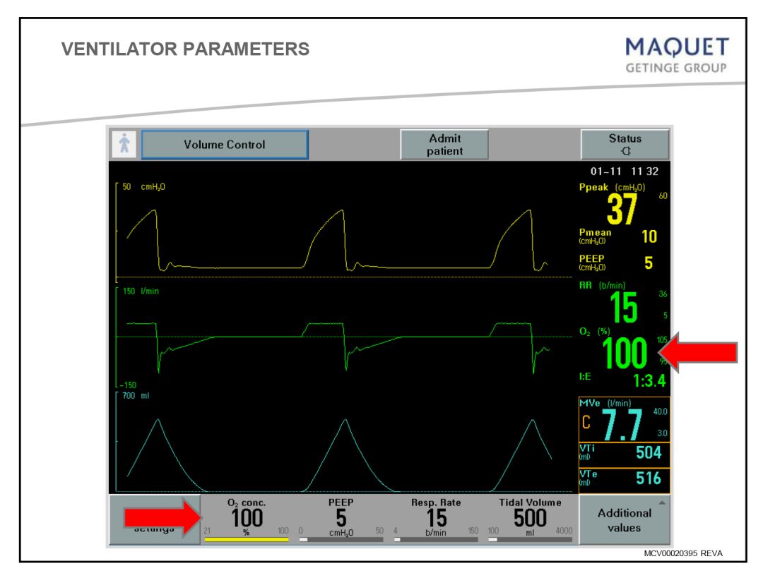 呼吸机怎么看呼吸机最全指南：让护士碰到呼吸机参数不再慌！_https://www.jmylbn.com_新闻资讯_第6张
