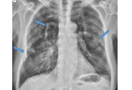 肺 尖 部 胸膜 肥厚
