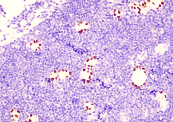 什么是病理蜡块病理新技术之“细胞蜡块”，让胸腹水中查找恶性细胞从“大海捞针”到“探囊取物”！_https://www.jmylbn.com_新闻资讯_第4张