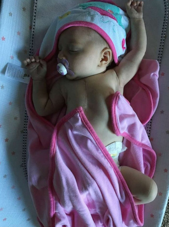 手术拉链怎么拆怀孕 33 周查出胎儿严重先心病，出生 3 天就开胸！4 岁女孩胸口的手术疤痕，爸爸竟纹了个一模一样的_https://www.jmylbn.com_新闻资讯_第2张