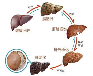 脂肪肝解剖图图片