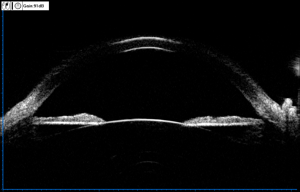 眼科a超怎么做眼部A型超声与眼部B型超声区别（专业篇）_https://www.jmylbn.com_新闻资讯_第6张