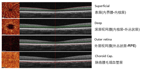 视网膜分层oct图片