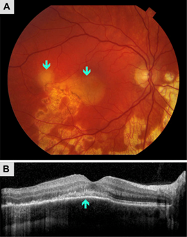 图6  sc的眼底像(a)及oct表现(b)5 鸟枪弹样视网膜脉络膜病这种疾病