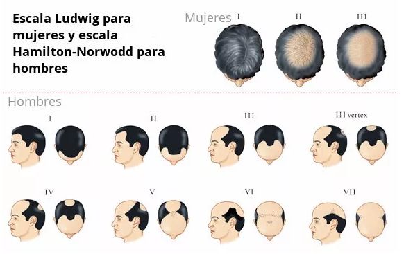 治疗脂溢性脱发，避免误区选对方法很重要！