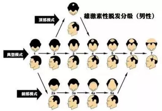 怎么判断自己是不是“雄秃”呢？