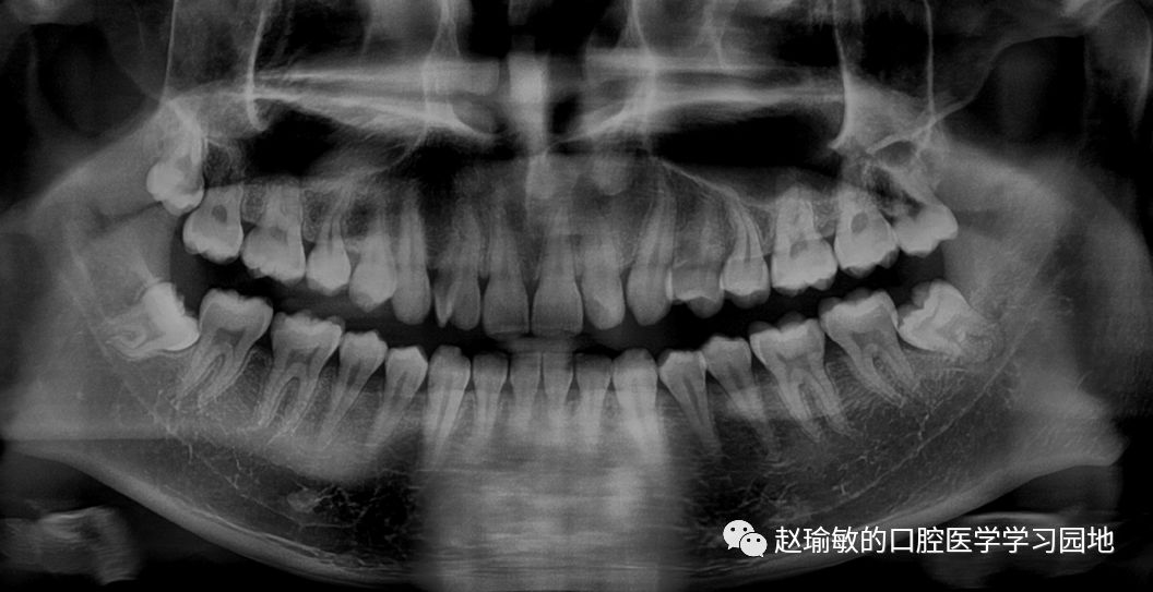 左下后牙阻生牙拔除一例 赵瑜敏的口腔医学学习园地 微信公众号文章阅读 Wemp